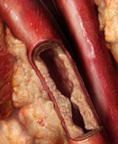 Artery Plaque
