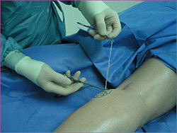 Ambulatory phlebectomy surgery