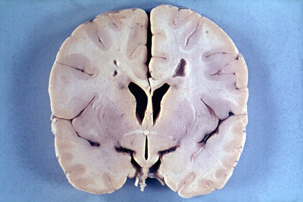 Neuropathology of Alexander Disease