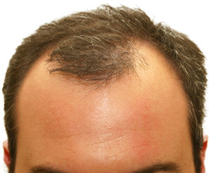 Front Head Hair Loss