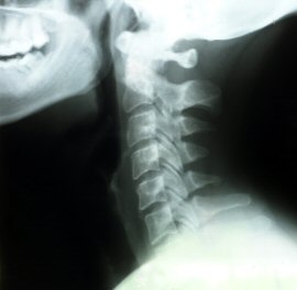 X-ray of neck