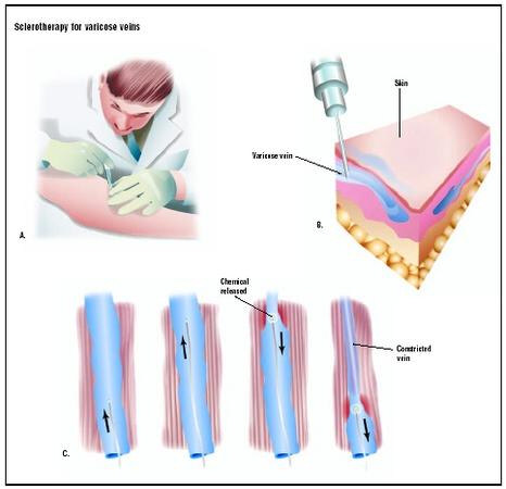 Sclerotherapy Treatment