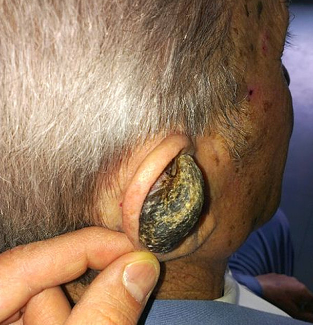 Cornu Cutaneum Located on Ear