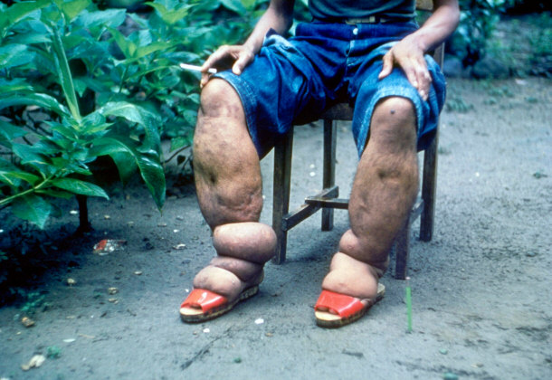 Man With Elephantiasis