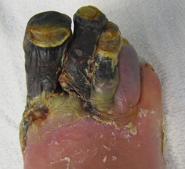 Diabetic Wet Gangrene