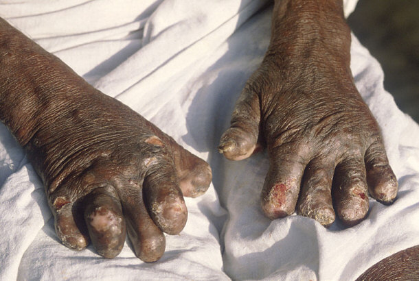 Leprosy Deformities on Hands
