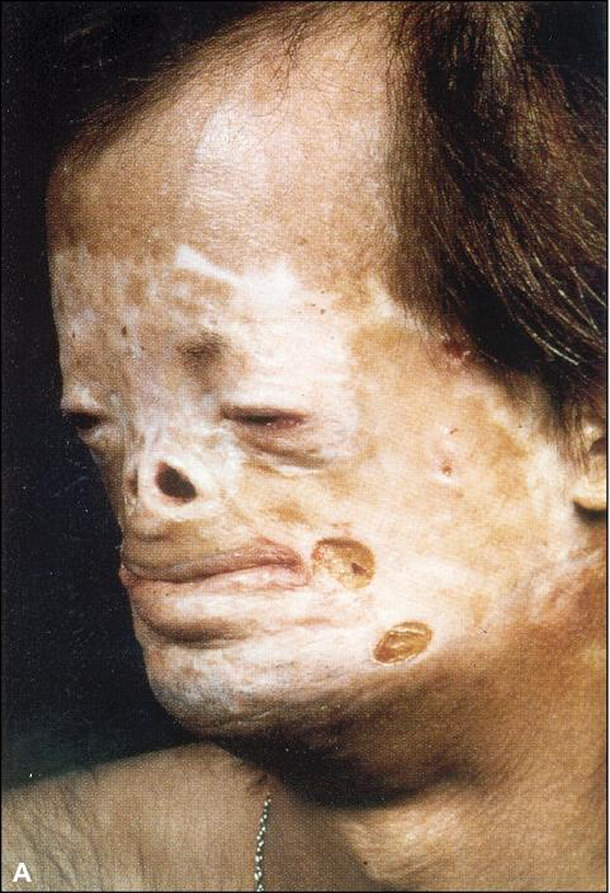 Man With Porphyria