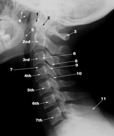 spinal x-ray of neck