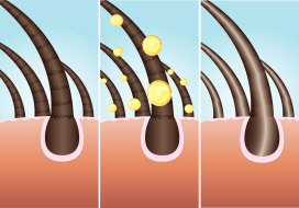 Dandruff in hair and scalp