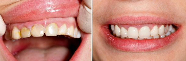 Before and After Dental Treatment