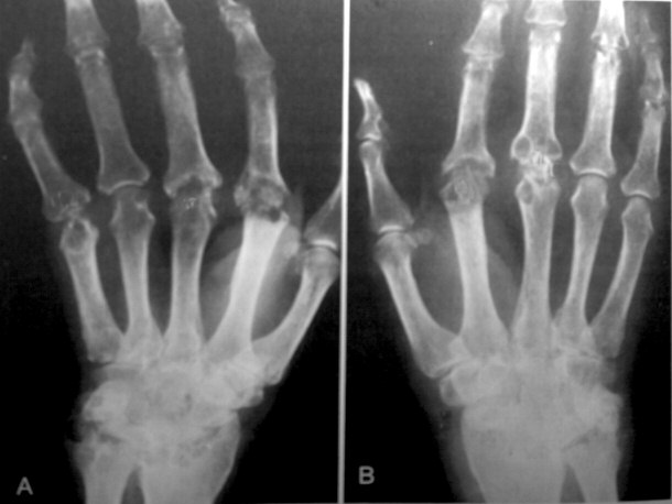 X-ray Showing Advancement of Rheumatoid Arthritis
