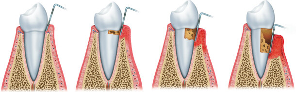 Stages of Development of Periodontitis (Gum Disease)