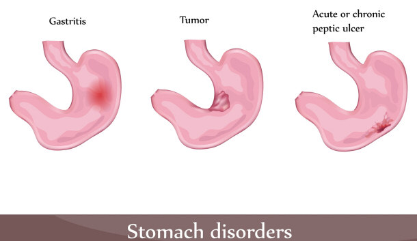 stomach disorders - ulcers brought on by poor dental health