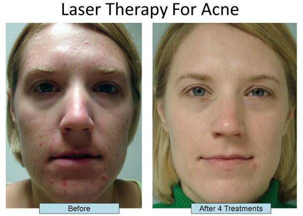 Before and After Laser Therapy for Acne Treatment