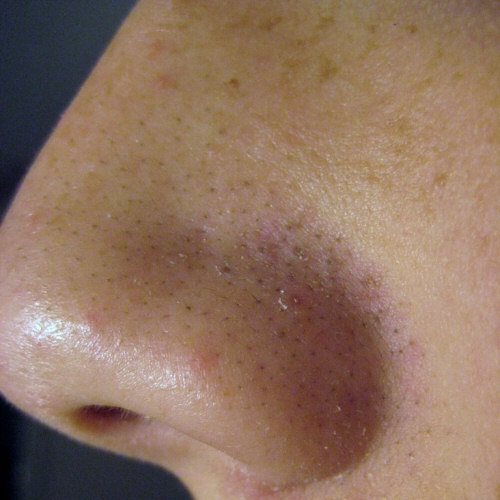 Close-up of a Common Comedo Referred to as Blackheads: