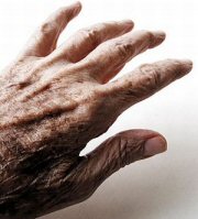 Dry Hand and D deficiency 