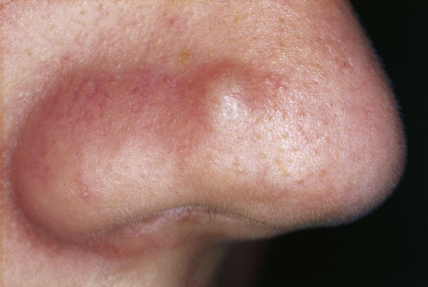 Fibrous Papule of the Nose: