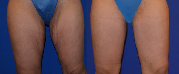 Thigh Lift before and after Photo