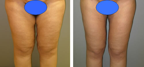 Before and after thighplasty surgery