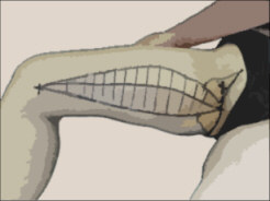 General area of thighplasty incisions