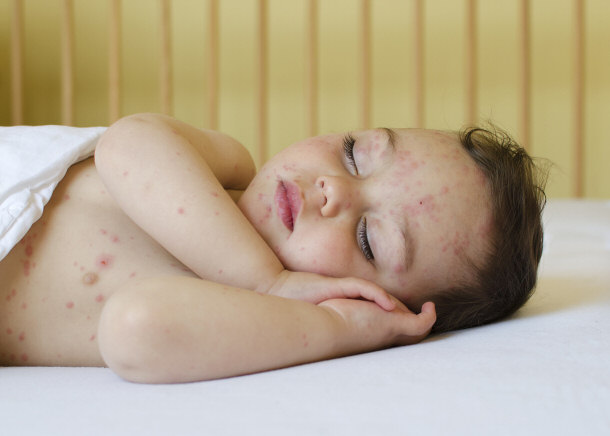 Child With Chicken Pox