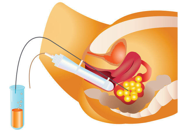 Egg Retrieval Procedure Before In Vitro Fertilization