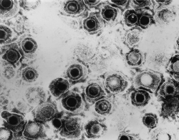 Transmission Electron Micrograph of Herpes Simplex Virus
