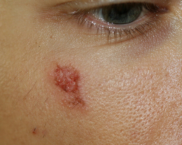 Kissing Bug bite