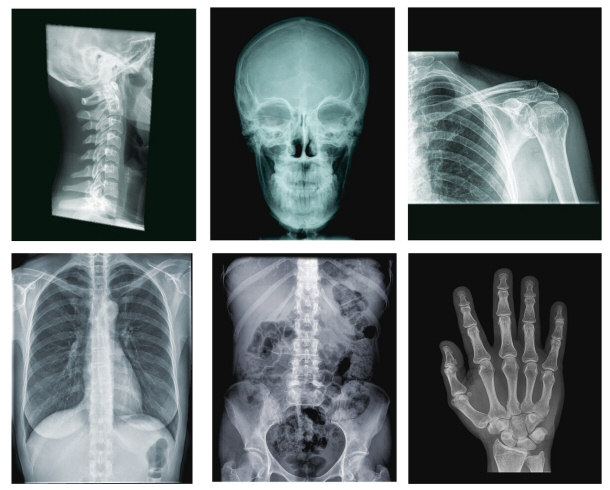 X-rays