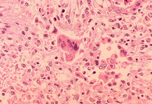 Histopathology of Measles Pneumonia - Possible Cause of Antonine Plague