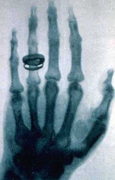 early xray