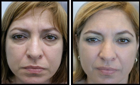 The Difference Between The Before And After Picture Is Astounding In This Belpharoplasty Eye Surgery Eyelid Surgery Men