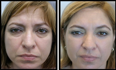 Before and after Blepharoplasty