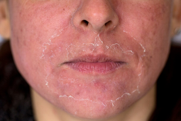 face peeling side effects face peeling side effects