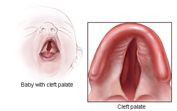 Cleft Palate