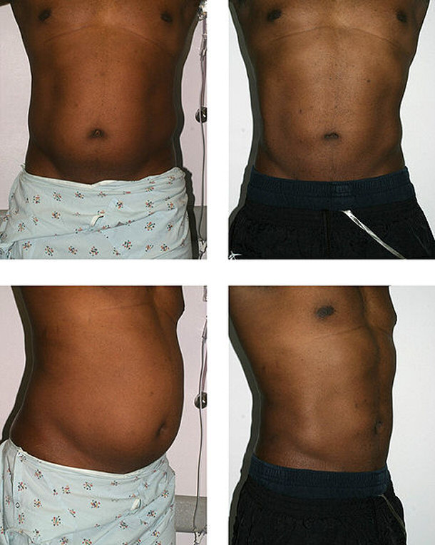 Treatments of Lipo Sculpting