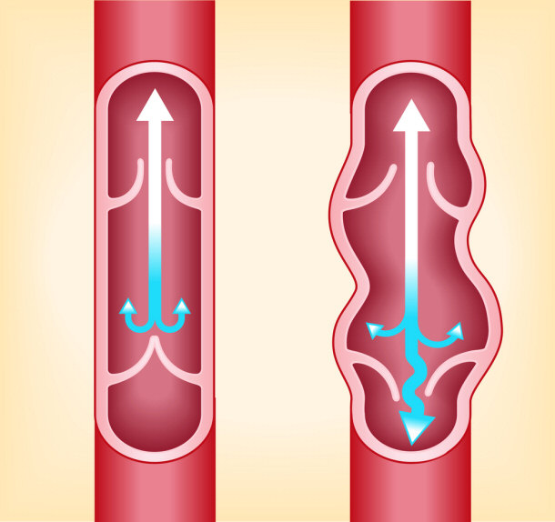 Normal Vein to the Right, Varicose to the Left