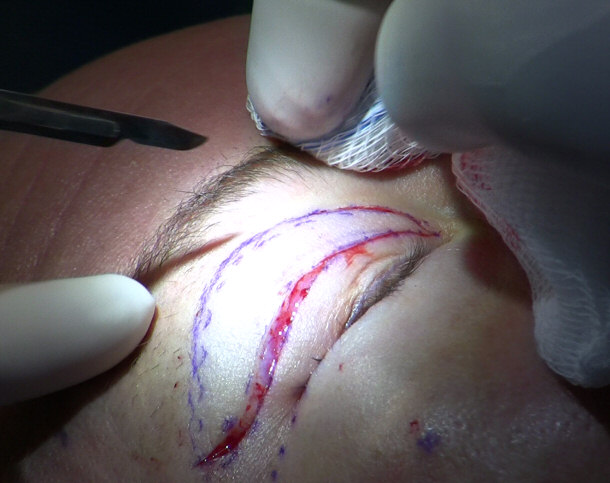 Incisions Made During an Upper Eyelid Blepharoplasty