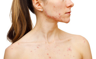 Acne scars