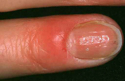 If germs enter your skin through the exposed fold, they can cause infections like paronychia