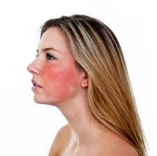 Rose inflammation on the face