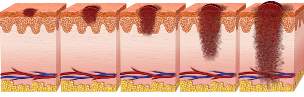 stages of melanoma