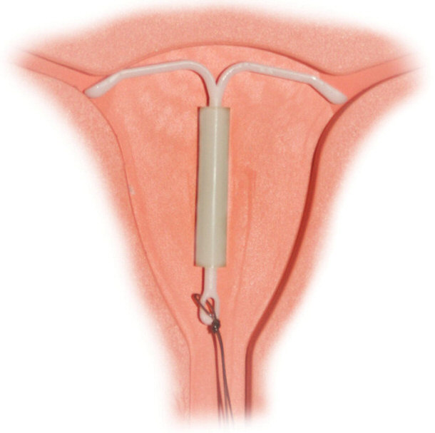 intrauterine system implant