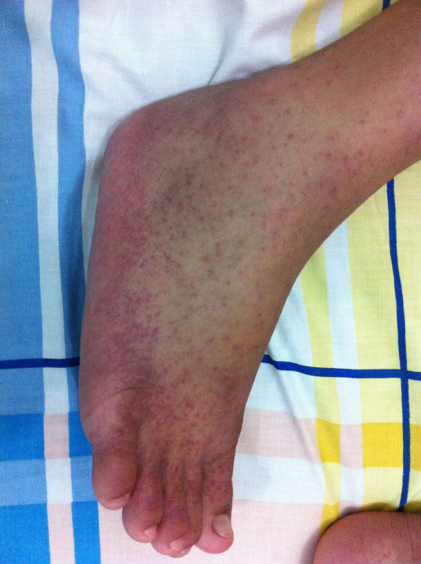 A Case if the Chikungunya disease
