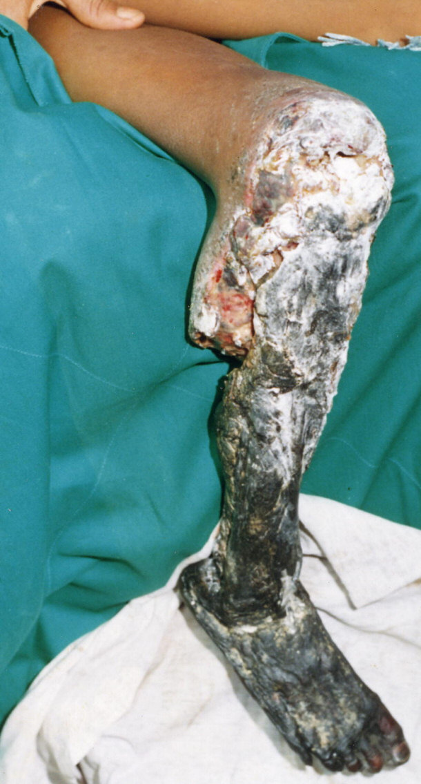 Aftermath of a Bothrops asper Bite on a 11-year-old Boy