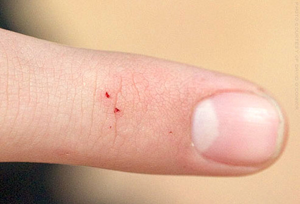 Example of a Spider Bite