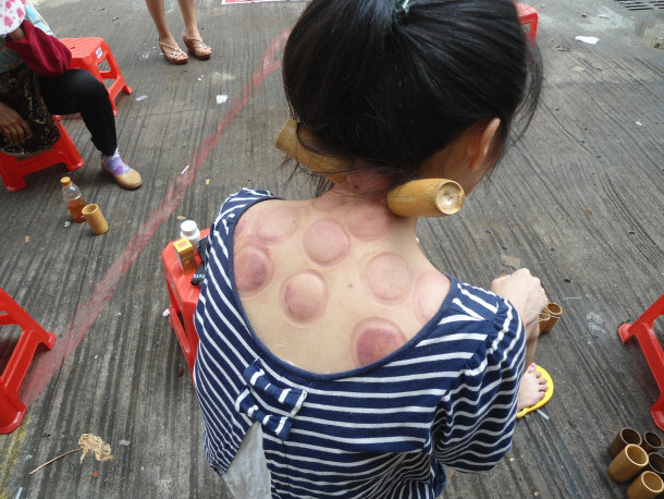 Fire Cupping is Another Part of Acupuncture Therapy