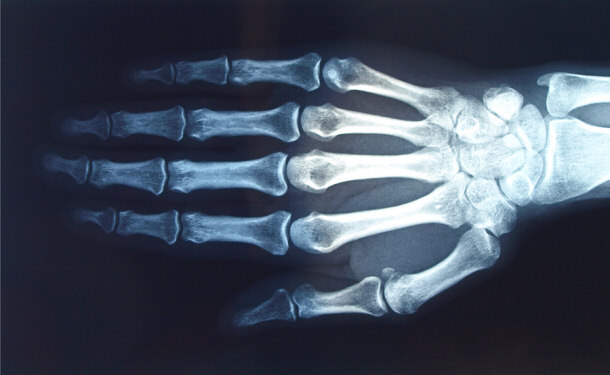 X Ray of human hand