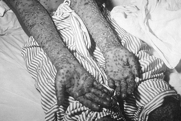 Patient With Advanced Smallpox Infection