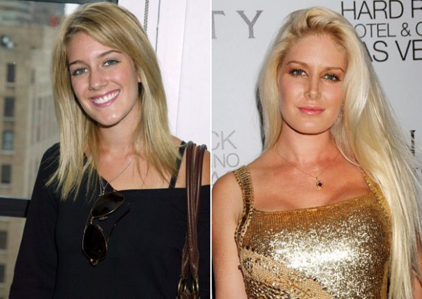 Heidi Montag Before and After Surgery